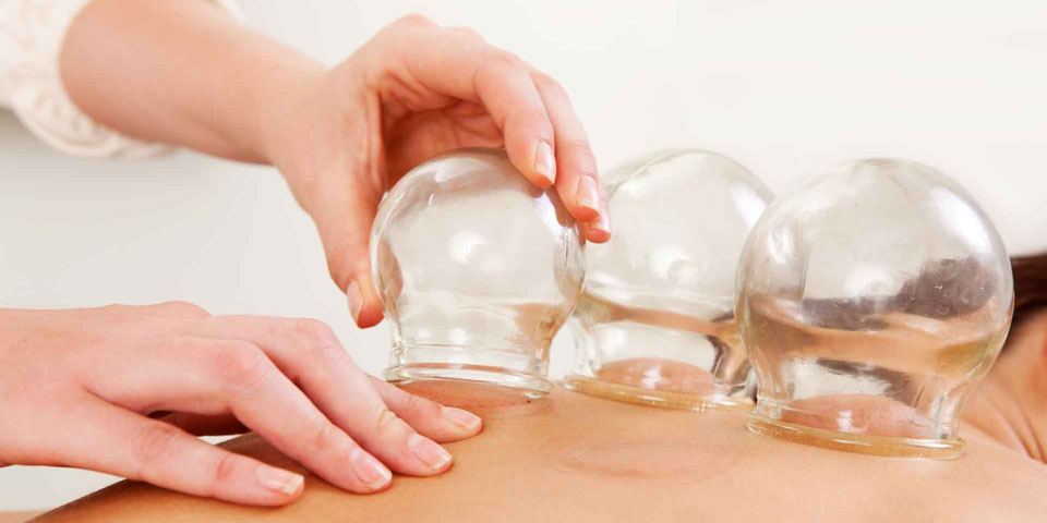 Cupping